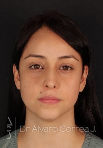 Rinoplastia Exceso de Dorso, Columela Colgante, Implante paranasal - Medellin, Colombia