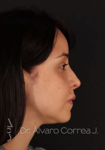 Rinoplastia Exceso de Dorso, Columela Colgante, Implante paranasal - Medellin, Colombia