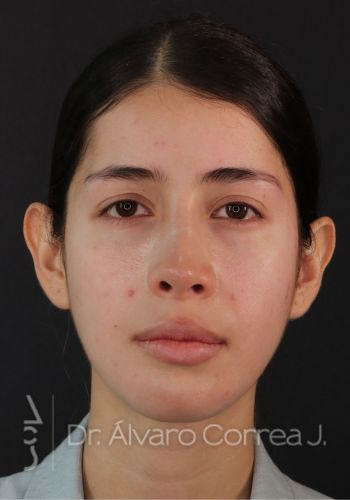 Rinoplastia Exceso de Dorso, Columela Retraida, Implante premaxilar - Medellin, Colombia