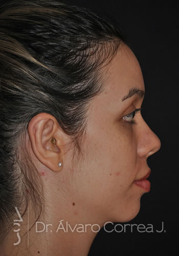 Otoplastia Falta Doblez, Otoplastia Exceso Concha - Medellin, Colombia