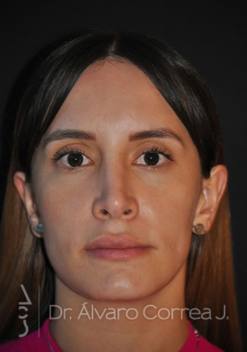 Rinoplastia Exceso de Dorso, Columela Colgante, Implante paranasal - Medellin, Colombia