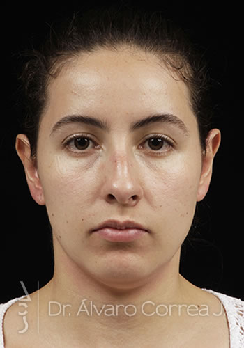 Rinoplastia Exceso de Dorso, Columela Colgante, Implante paranasal - Medellin, Colombia