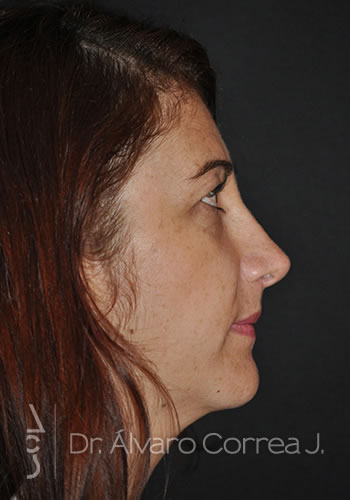 Rinoplastia Exceso de Dorso, Implante paranasal - Medellin, Colombia