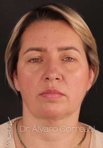 Rinoplastia Refinamiento Nasal, Blefaroplastia Superior - Medellin, Colombia