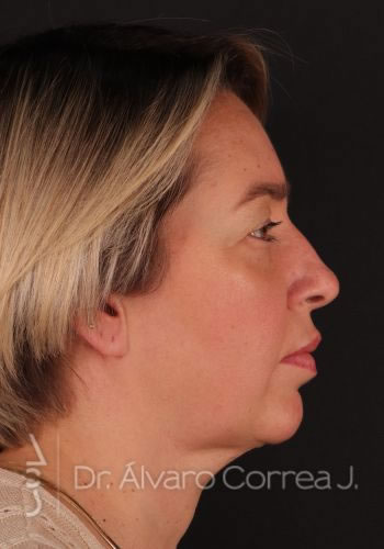 Rinoplastia Refinamiento Nasal, Blefaroplastia Superior - Medellin, Colombia