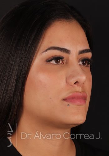 Rinoplastia Refinamiento Nasal, Implante paranasal - Medellin, Colombia