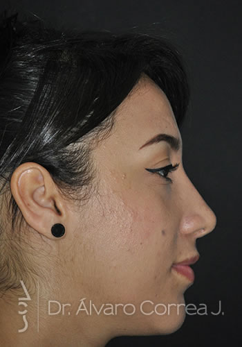 Rinoplastia Exceso de Dorso, Columela Retraida, Implante paranasal - Medellin, Colombia