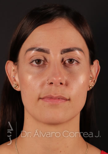 Rinoplastia Refinamiento Nasal - Medellin, Colombia