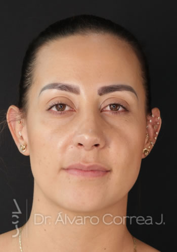 Rinoplastia Refinamiento Nasal - Medellin, Colombia