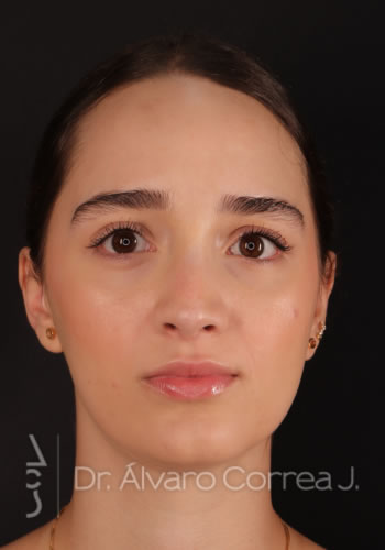 Rinoplastia Refinamiento Nasal - Medellin, Colombia