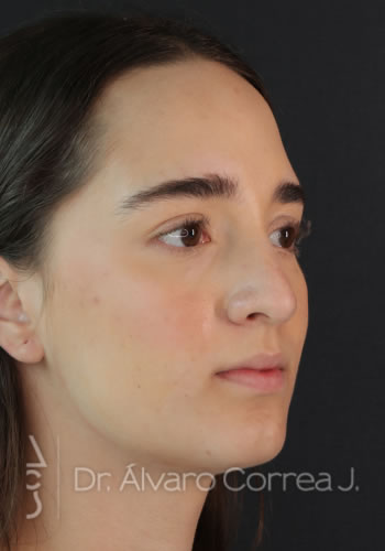 Rinoplastia Refinamiento Nasal - Medellin, Colombia