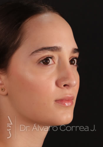 Rinoplastia Refinamiento Nasal - Medellin, Colombia