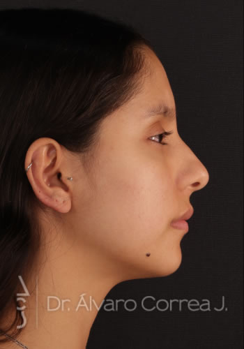 Rinoplastia Refinamiento Nasal - Medellin, Colombia