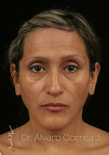 Rinoplastia Punta Caida, Exceso de Dorso, Columela Retraida, Implante paranasal, Implante premaxilar - Medellin, Colombia