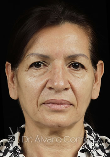 Implante paranasal, Blefaroplastia Superior - Medellin, Colombia