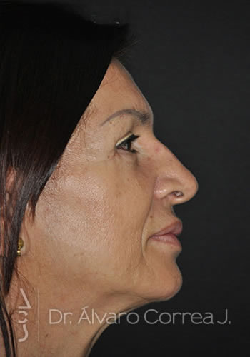 Implante paranasal, Blefaroplastia Superior - Medellin, Colombia