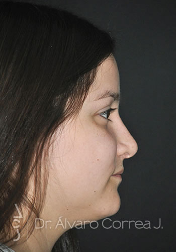 Rinoplastia Exceso de Dorso, Columela Colgante, Implante paranasal - Medellin, Colombia