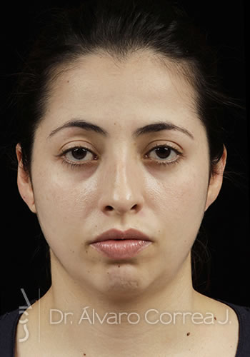 Rinoplastia Exceso de Dorso, Mentoplastia - Medellin, Colombia