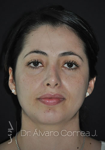 Rinoplastia Exceso de Dorso, Mentoplastia - Medellin, Colombia