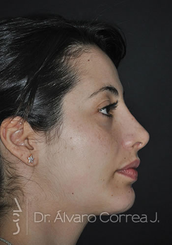 Rinoplastia Exceso de Dorso, Mentoplastia - Medellin, Colombia