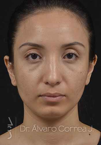 Rinoplastia Punta Caida, Exceso de Dorso, Mentoplastia, Implante paranasal - Medellin, Colombia