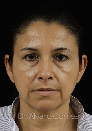 Implante paranasal, Blefaroplastia Superior - Medellin, Colombia