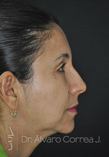 Implante paranasal, Blefaroplastia Superior - Medellin, Colombia