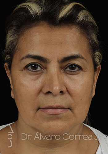 Rinoplastia Punta Caida, Exceso de Dorso, Implante paranasal, Blefaroplastia Superior - Medellin, Colombia