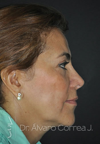 Rinoplastia Punta Caida, Exceso de Dorso, Implante paranasal, Blefaroplastia Superior - Medellin, Colombia