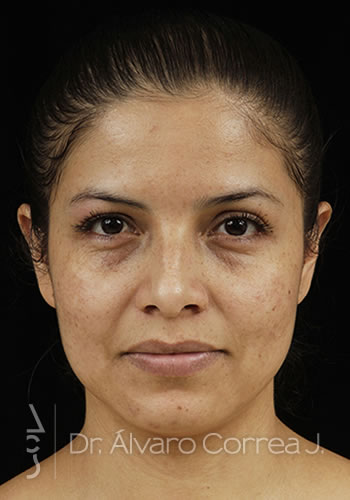 Rinoplastia Exceso de Dorso, Implante paranasal - Medellin, Colombia