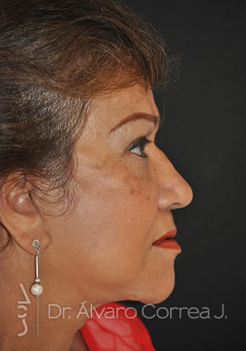 Implante paranasal, Blefaroplastia Superior, Cervicoplastia, Ritidoplastia - Medellin, Colombia