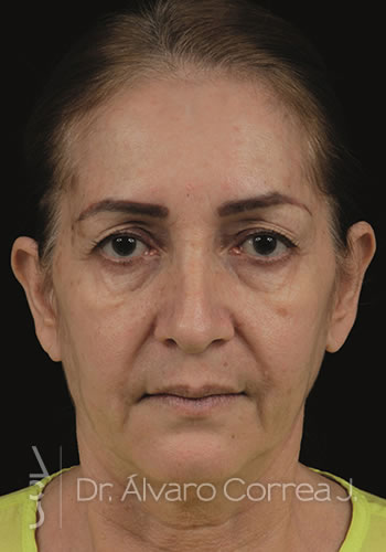 Blefaroplastia Superior e Inferior, Ritidoplastia, Ritidoplastia Tercio Medio - Medellin, Colombia