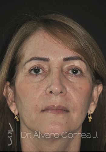 Blefaroplastia Superior e Inferior, Ritidoplastia, Ritidoplastia Tercio Medio - Medellin, Colombia