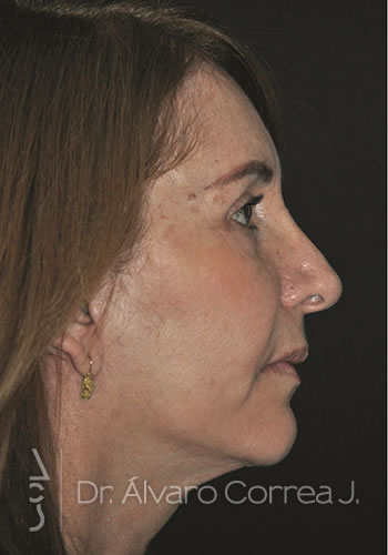 Blefaroplastia Superior e Inferior, Ritidoplastia, Ritidoplastia Tercio Medio - Medellin, Colombia