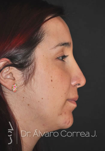 Rinoplastia Punta Caida, Exceso de Dorso, Implante paranasal - Medellin, Colombia