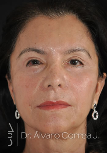 Implante paranasal, Blefaroplastia Superior e Inferior, Ritidoplastia Tercio Medio - Medellin, Colombia