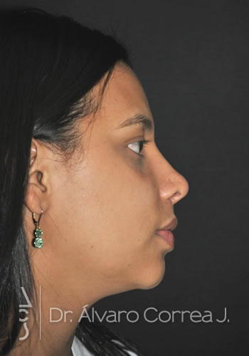 Rinoplastia Punta Ancha, Exceso de Dorso, Base Nasal Ancha - Medellin, Colombia