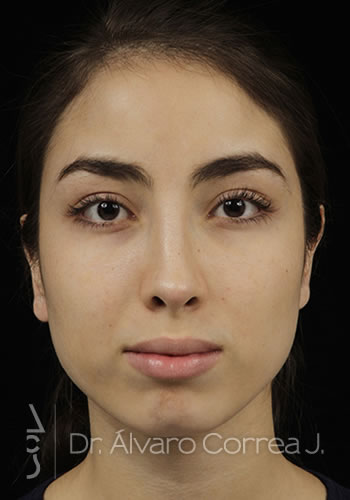 Rinoplastia Exceso de Dorso - Medellin, Colombia