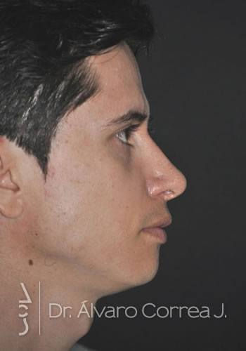 Rinoplastia Punta Caida, Exceso de Dorso - Medellin, Colombia