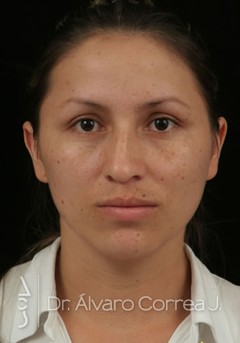 Rinoplastia Punta Caida, Exceso de Dorso, Desviación Nasal, Implante paranasal, Implante premaxilar, Implante Barras Laterales - Medellin, Colombia