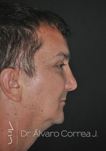 Rinoplastia Punta Caida, Implante paranasal, Blefaroplastia Superior e Inferior, Frontoplastia, Ritidoplastia Tercio Medio - Medellin, Colombia