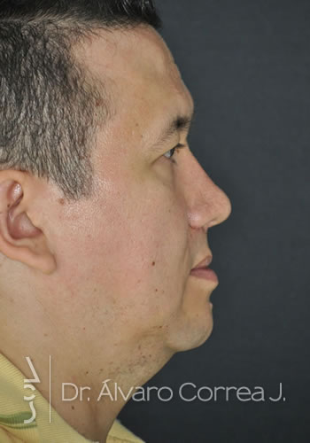 Rinoplastia Falta de Dorso, Columela Retraida, Implante paranasal, Implante premaxilar - Medellin, Colombia