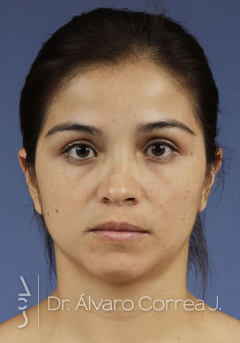 Rinoplastia Desviación Nasal, Implante paranasal - Medellin, Colombia