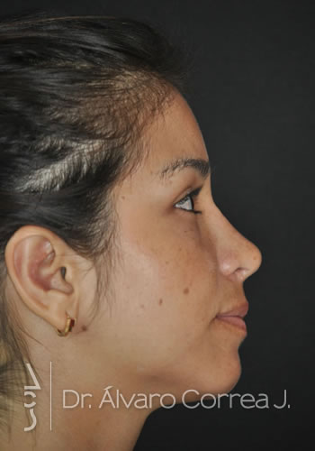 Rinoplastia Desviación Nasal, Implante paranasal - Medellin, Colombia