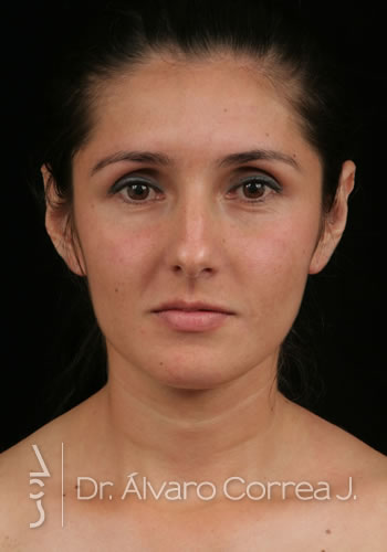 Rinoplastia Exceso de Dorso - Medellin, Colombia