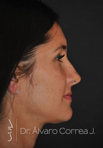 Rinoplastia Exceso de Dorso - Medellin, Colombia