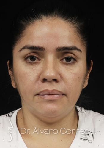 Rinoplastia Punta Ancha, Columela Retraida, Desviación Nasal, Implante paranasal - Medellin, Colombia