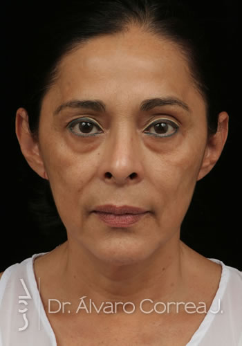 Implante paranasal, Blefaroplastia Inferior, Ritidoplastia - Medellin, Colombia