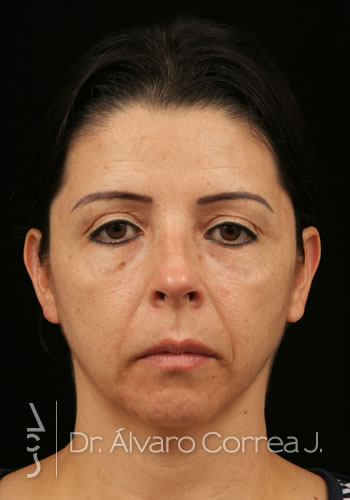 Rinoplastia Exceso de Dorso, Mentoplastia, Implante paranasal - Medellin, Colombia