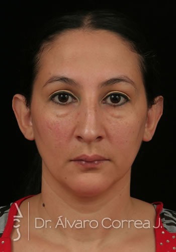 Rinoplastia Exceso de Dorso, Desviación Nasal, Implante paranasal - Medellin, Colombia